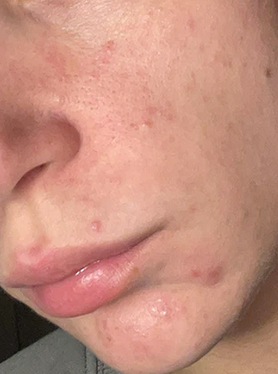 Skin glow treatment before